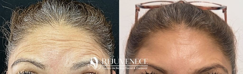 Caso clínico real de rejuvenecimiento facial